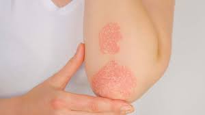 Psoriasis: Understanding the Multifaceted Causes