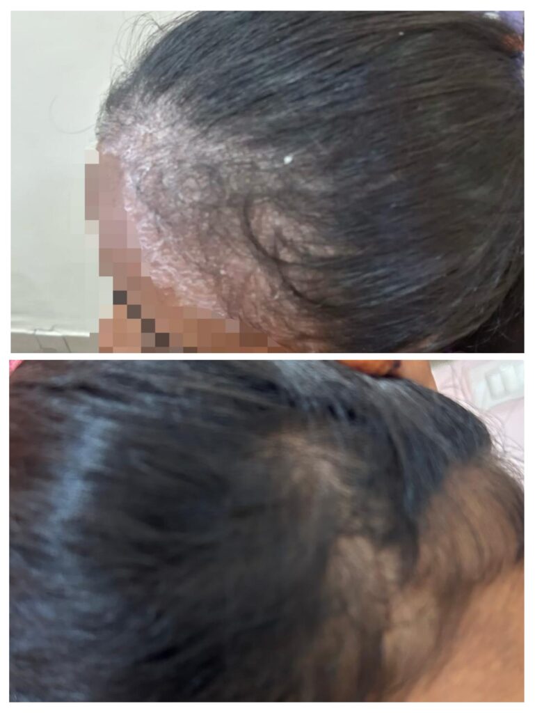 Before and after Ayurvedic treatment for scalp psoriasis at KR Herbs Hyderabad – 2 months results”